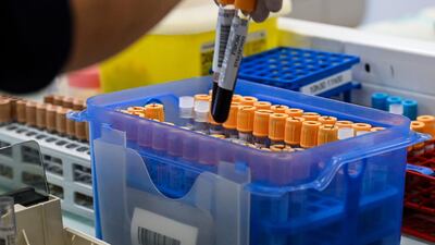 Another study has suggested that blood type may play a role in the severity of Covid-19. AFP