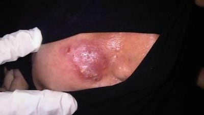 One of the victims of the three impostors who were caught offering illegal cosmetic services shows the injuries to her right cheek. Photo courtesy of Dr Ibrahim Galadari, professor of dermatology at UAE University.