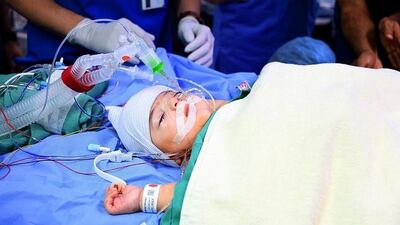 The Libyan twins, Ahmed and Mohammed, were born in Tripoli in June and were joined at the lower abdomen and pelvis.