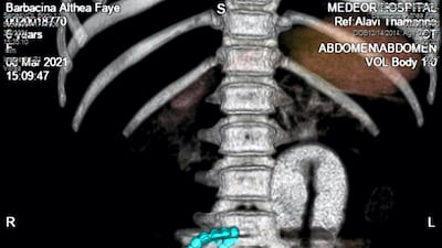 An X-ray image taken of 6-year-old Althea Faye Barabacina with 11 high-powered magnets in her intestines. Courtesy, Medeor Hospital