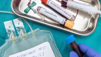 RPMG9J blood sample to investigate remedy against Alzheimer's disease. Alamy