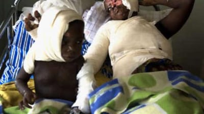 Regina Nannono and her two-year-old daughter Aleni, victims of a vicious acid attack, lie in Kampala's Mulago Hospital.