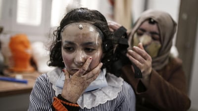 Maram's mother has two masks to help her burns heal - one for the day and another to be worn along with pair of gloves when she sleeps at night. AFP