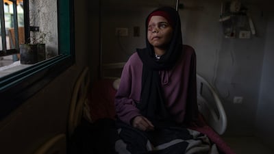 Palestinian girl Nada Arhouma, 15, who was injured in an Israeli air strike on a displacement camp in Khan Younis, receives medical treatment at Nasser Hospital in the Gaza Strip. EPA