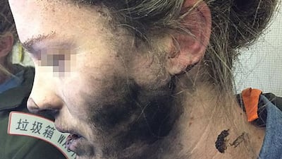 An undated handout photo made available by the Australian Transport Safety Bureau (ATSB) on 15 March 2017 shows a woman with facial injuries after her headphones caught fire on a flight from Beijing to Melbourne. EPA