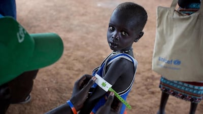 In this photo taken Thursday, Oct. 20, 2016 and released by Unicef, a boy has his arm measured to see if he is suffering from malnutrition during a nutritional assessment at an emergency medical facility supported by Unicef in Kuach, on the road to Leer, in South Sudan. The country declared famine in two counties on February 20, 2017 in two counties of South Sudan, as UN aid agencies said the calamity was 'man-made'. Kate Holt/Unicef via AP