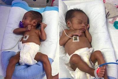 Twin sisters Adori Emanuela and Amori Nathaniela in the hospital. Courtesy: Monica Pentio Tubo