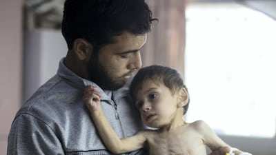 Four-year-old Omar is hugged by his father Saed Mohamed Al aradee.