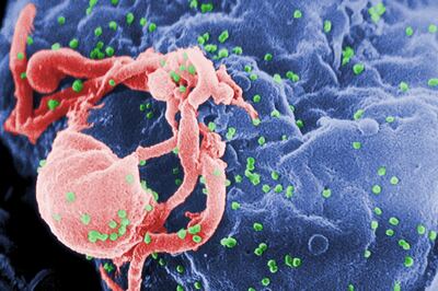 This photo provided shows a scanning electron micrograph of multiple round bumps of the HIV-1 virus on a cell surface. Courtesy: CDC