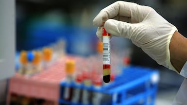 LDL cholesterol is behind a third of all heart disease deaths and a quarter of all stroke deaths worldwide. Getty Images