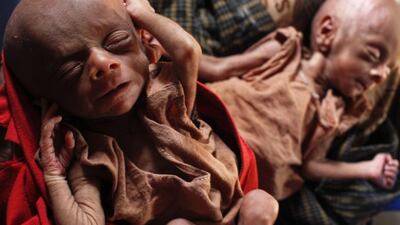 Severely malnourished 25-day-old twins are held by her mother Norbagoun, a displaced Rohingya woman, in their house at the Dar Paing camp for internally displaced people in Sittwe, Rakhine state.