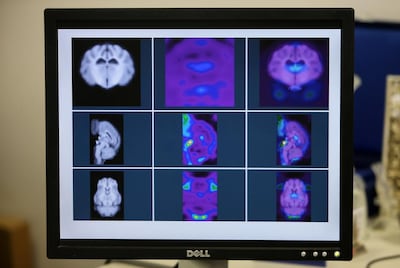 A brain scan can help diagnose Parkinson’s disease earlier, which may lead to better treatment. Pawan Singh / The National
