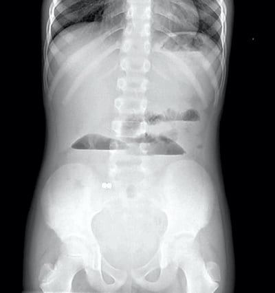 An X-ray showing two of the magnetic spheres in a child's stomach.