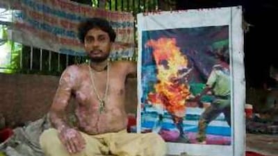 Rajnish Kumar displays burn scars and a photograph of himself when he poured kerosene over his body and set himself on fire.