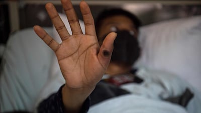A patient infected with the Mpox virus in Lima, Peru. AFP