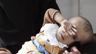A woman holds her malnourished child at a therapeutic feeding center at Al Sabyeen hospital in Sanaa. Mohamed al-Sayaghi / Reuters
