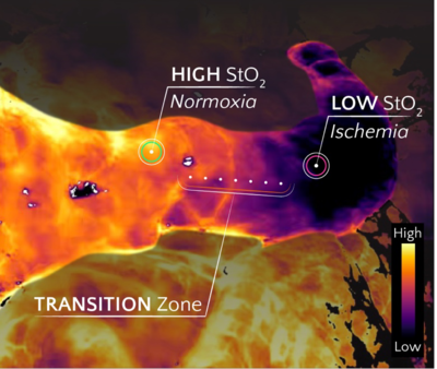 Being able to better see tissue health during surgery could prevent many complications, and a device invented in the UK aims to do that. Photo: Hypervision Surgical