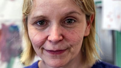 Marks made from wearing PPE are pictured on the face of nurse Susie Jewsbury, who works on the intensive care unit at Frimley Park Hospital in Frimley, south-west England. AFP