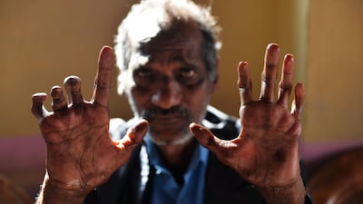 Shiv Shankar Tiwari, 62, a cured leprosy patient shows his disfigured hands.