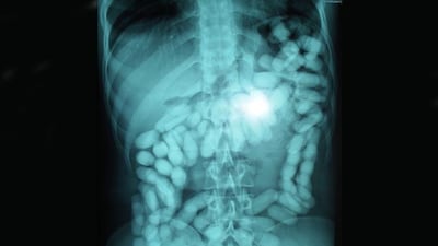 Packages of illegal drugs can be clearly seen in this X-ray of a smuggler's stomach. Courtesy: Royal Oman Police