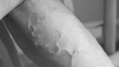 Varicose veins affects about one in three people. BSIP / UIG via Getty Images