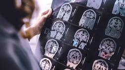 Figures show that 42 per cent of Americans develop the condition at some time after the age of 55. Adobe