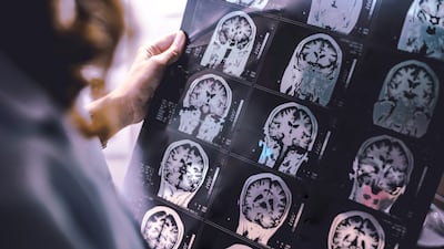Figures show that 42 per cent of Americans develop the condition at some time after the age of 55. Adobe
