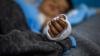 A boy lies on a hospital bed in Hasakeh after a fire hit a wedding reception at Al Hol displacement camp in north-eastern Syria. AFP