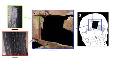 Evidence of early brain surgery in Israel. Rachel Kalisher