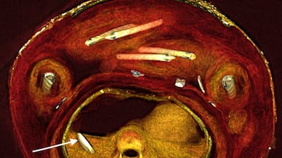 CT scans allowed researchers to learn more about the mummy, without damaging it by breaking open its seal
