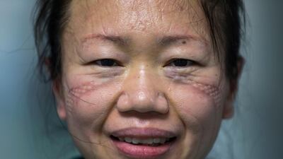 Scar marks made from wearing protective mask left on a face of a nurse at Jinyintan Hospital designated for new coronavirus infected patients, in Wuhan in central China's Hubei province. AP