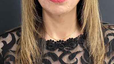 Heba Hosni, who was the victim of an acid attack in 2008, returned to Egypt after eight operations in two years in Dubai to reconstruct her face. Courtesy: Dr Mohan Rangaswamy