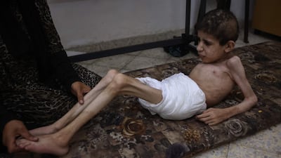Bahaa Al Nimr, 19, who suffers from cerebral palsy and malnutrition, is cared for by his mother Sahar at their home in the Sheikh Radwan neighbourhood in the north of Gaza city. AFP