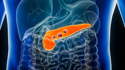 Pancreatic cancer has survival rates of less than five per cent. Getty Images