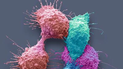 Ovarian cancer cells. Low-grade serous ovarian cancer accounts for 5 per cent of epithelial ovarian cancers, which represents 95 per cent of the disease. Getty Images