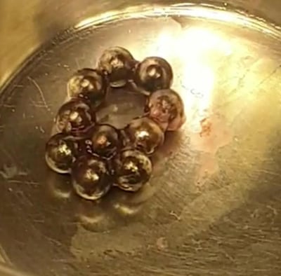 The high-powered magnetic beads recovered from six-year-old Althea's intestines. Courtesy Medeor Hospital