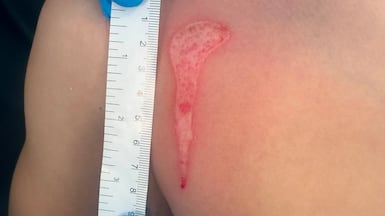 Heating slime and squishy toys in microwaves has caused injuries in Scotland. Photo: NHS Greater Glasgow and Clyde/PA