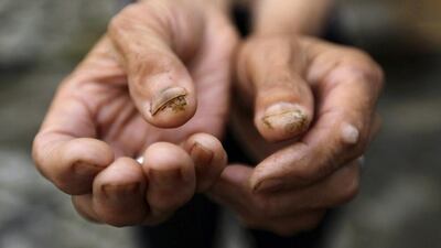 Qin Zhengyu, 78, who suffers from skin cancer, shows tumours on her fingers, at Heshan village. Jason Lee / Reuters