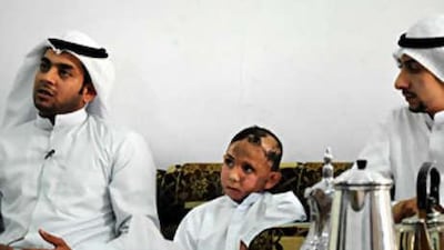 Waheed, 4, endured three months of treatment for burns, and needs further plastic surgery which he must seek in Europe.