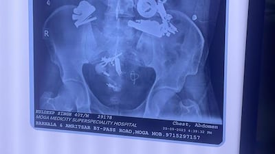 An X-ray showing 150 foreign objects in a man's stomach at Medicity Hospital in Moga, Punjab, India. Ajemr Kalra / Moga Hospital