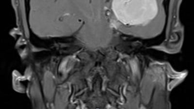 A scan of the tumour that was removed from Mohanad Emaara's brain