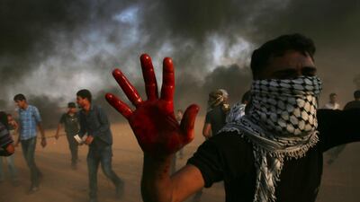 A protester shows his bloody hand while helping a wounded youth as others burn tyres near the fence of the Gaza Strip border with Israel east of Khan Younis, southern Gaza Strip. AP