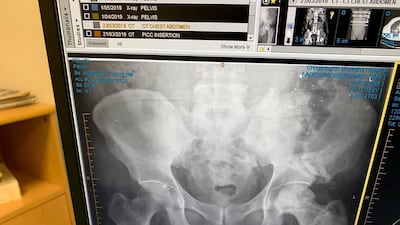 An x-ray from June 4 showing the bullet fragments in Sami’s hip, and the fracture of his hip bone. Courtesy Adeeb Sami.