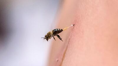 A bee stings the back of a patient receiving treatment at Sayed Al Sayeh's practice in the Egyptian city of Giza. AFP