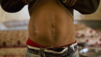 Akram shows the scars he sustained when ISIL militants attacked his town in 2014. ‘They started to shoot at us. My mother fell and I was hit. These are the bullet marks.’