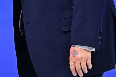 A bruise is visible on the back of US President Donald Trump's left hand in January. AFP