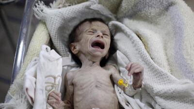 A Syrian infant suffering from severe malnutrition is seen at a clinic in Hamouria, Ghouta region on the outskirts of the capital Damascus. Amer Almohibany / AFP Photo / October 21, 2017