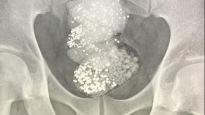 An X-ray reveals bags of diamonds in the bowels of a smuggler travelling into Sharjah International Airport. Courtesy Federal Customs Authority