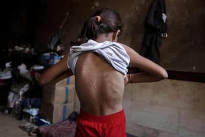 A girl infected with chickenpox shows the blisters on her back inside her family's tent in southern Gaza. AFP