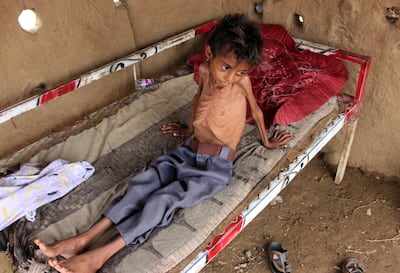 Hassan Razem, a 10-year-old child suffering from severe acute malnutrition, lies on a cot in the Abs district of Yemen's north-western Hajjah province. AFP